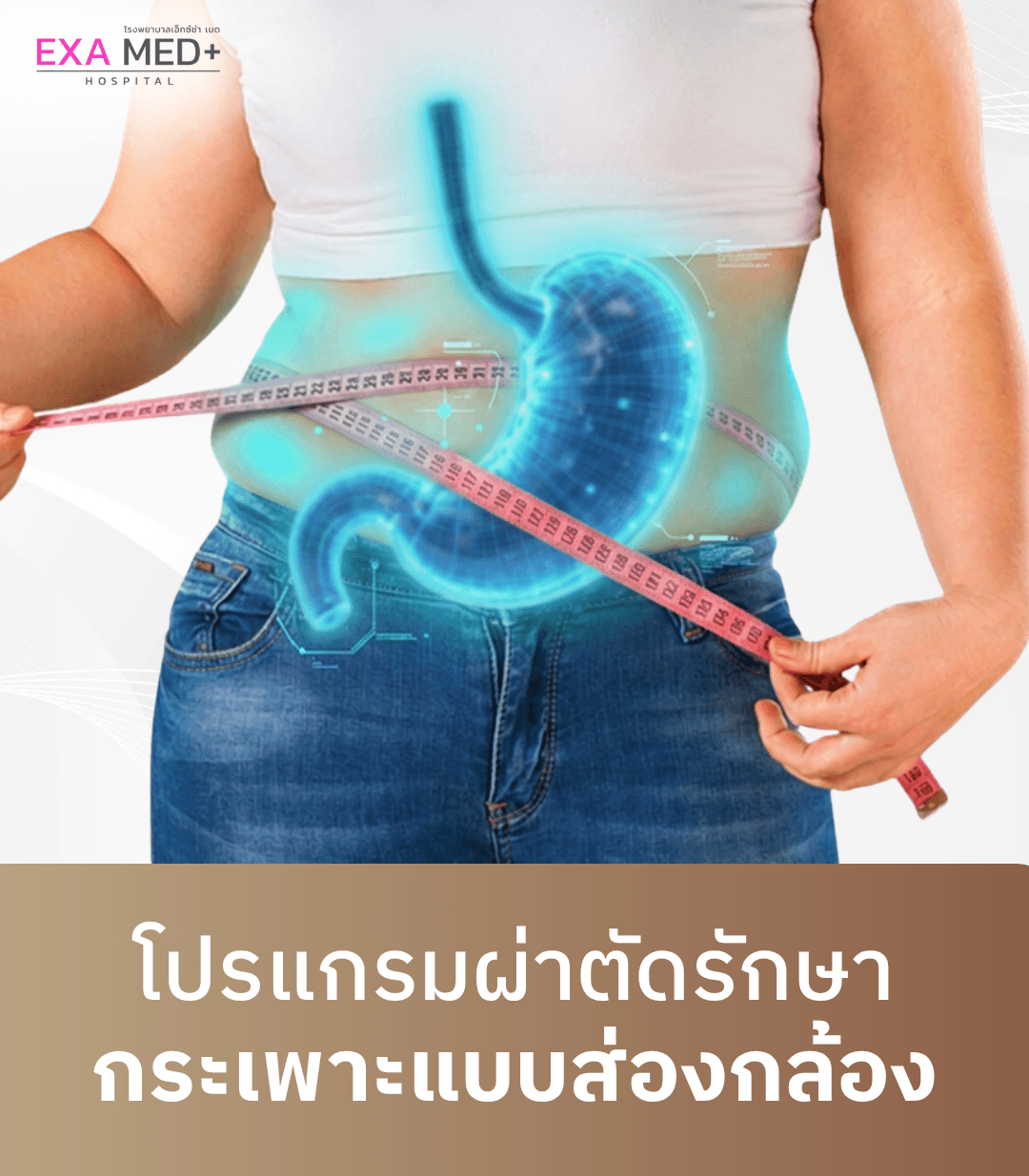 ผ่าตัดกระเพาะแบบส่องกล้อง