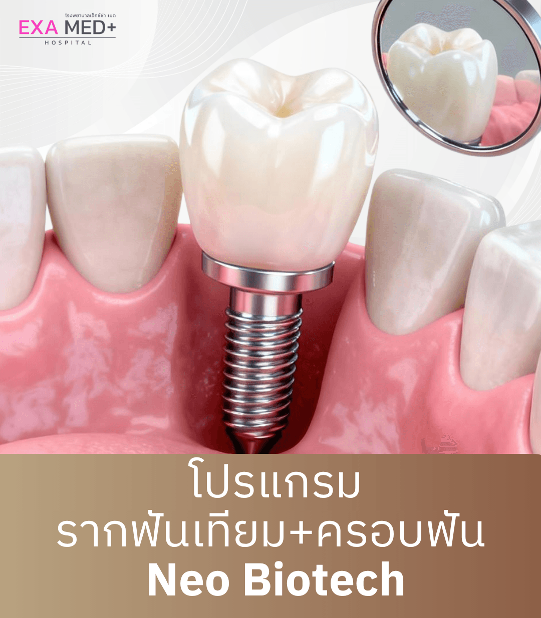 รากฟันเทียมพร้อมครอบฟัน NeoBiotech