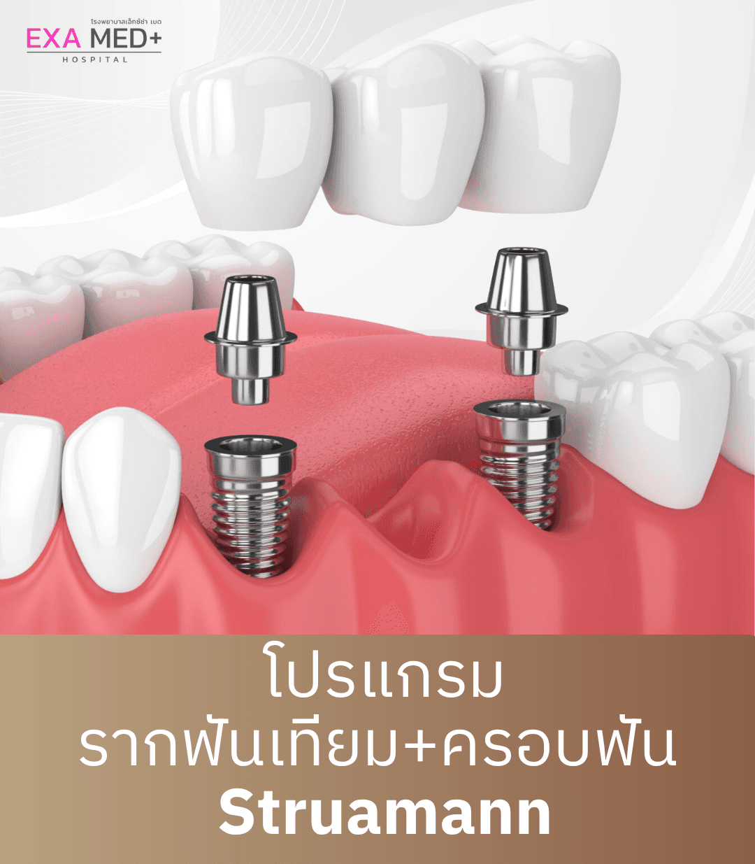 รากฟันเทียมพร้อมครอบฟัน Straumann